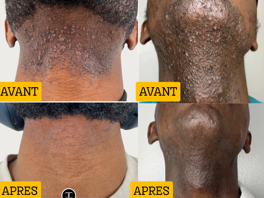 Dites enfin adieu aux boutons de rasage, aux poils incarnés et aux boutons  de la nuque