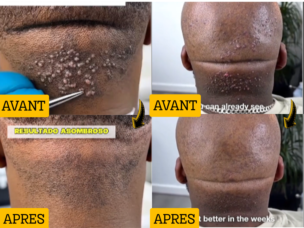Dites enfin adieu aux boutons de rasage, aux poils incarnés et aux boutons  de la nuque