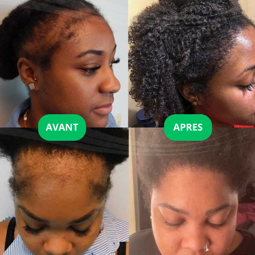 Le Pack Dermaroller PRO + Huile de Chébé: Stopper la chute de vos cheveux au niveau des Tempes