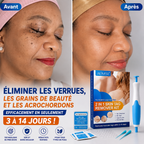 kit de retrait des verrues, grains de beauté et acrochordons / Homme et Femme: Eliminer les verrues en 3 a 14 JOURS