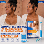 kit de retrait des verrues, grains de beauté et acrochordons / Homme et Femme: Eliminer les verrues en 3 a 14 JOURS