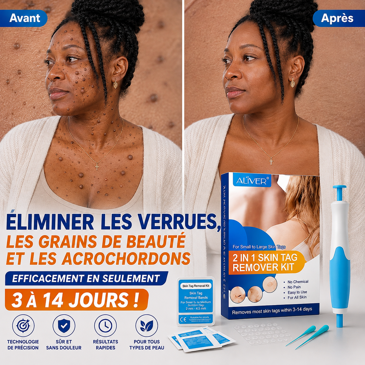 kit de retrait des verrues, grains de beauté et acrochordons / Homme et Femme: Eliminer les verrues en 3 a 14 JOURS