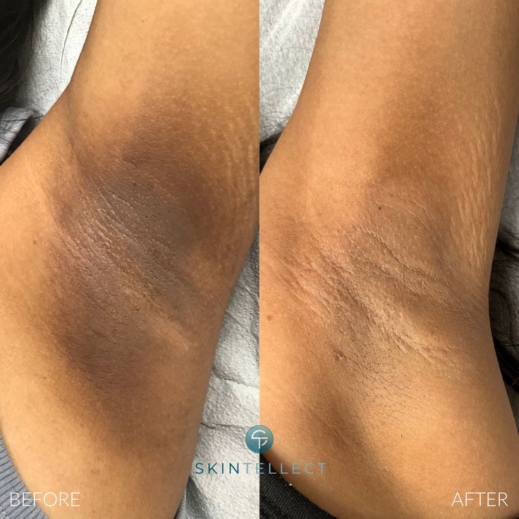 RETROUVEZ  UN TEINT UNIFORME EN QUELQUES JOURS: serum correctrice kormesic